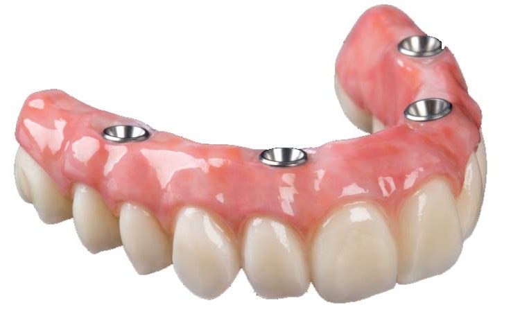 Implant Supported Dentures